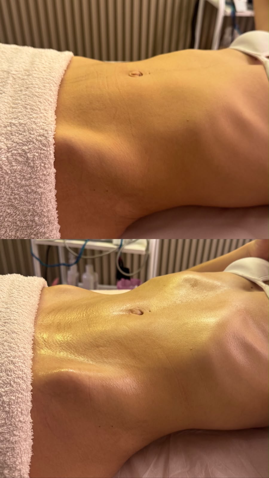 Comparativo fotográfico da região abdominal em atendimento corporal